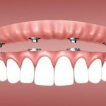 Implantes dentales o Prótesis dentales: ¿Cuál es más adecuado para ti?